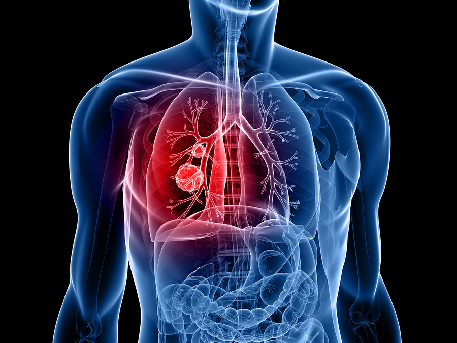 Wissenswertes Lungenkrebs